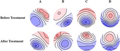 Prediction of Clinical Outcomes With EEG Microstate in Patients With Major Depressive Disorder